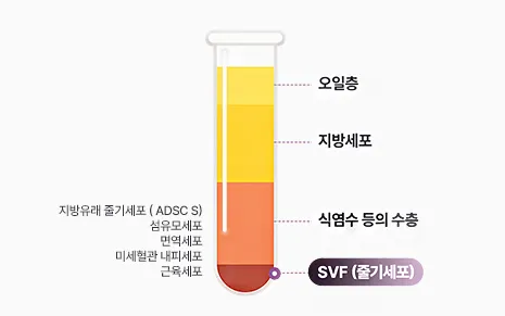 sc301의원 svf가슴성형 수술방법 두번째 이미지